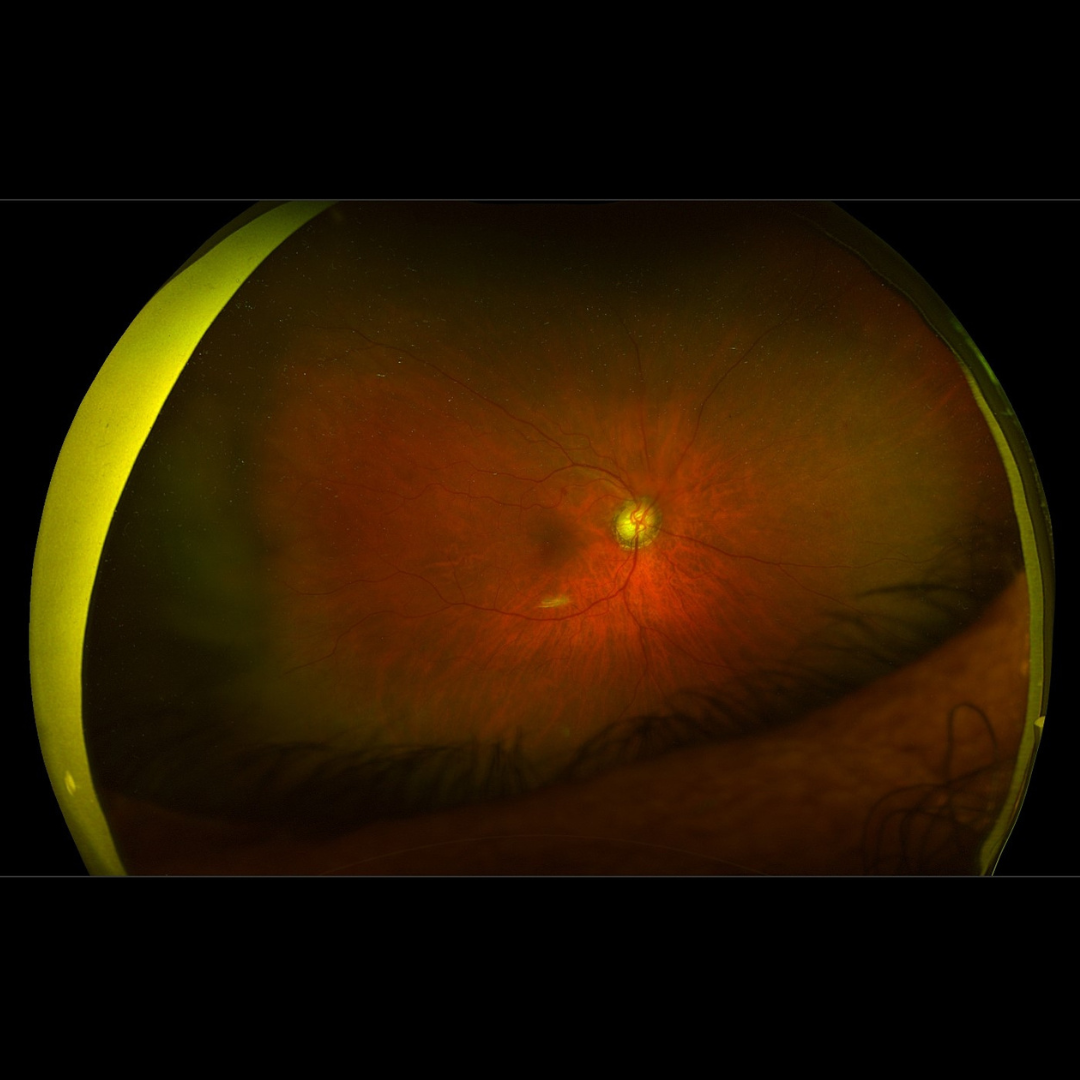 Trust Dr. Mandeep Lamba for expert care in Dubai! Specialized solutions for managing cataract surgery complications and ensuring the best recovery outcomes.