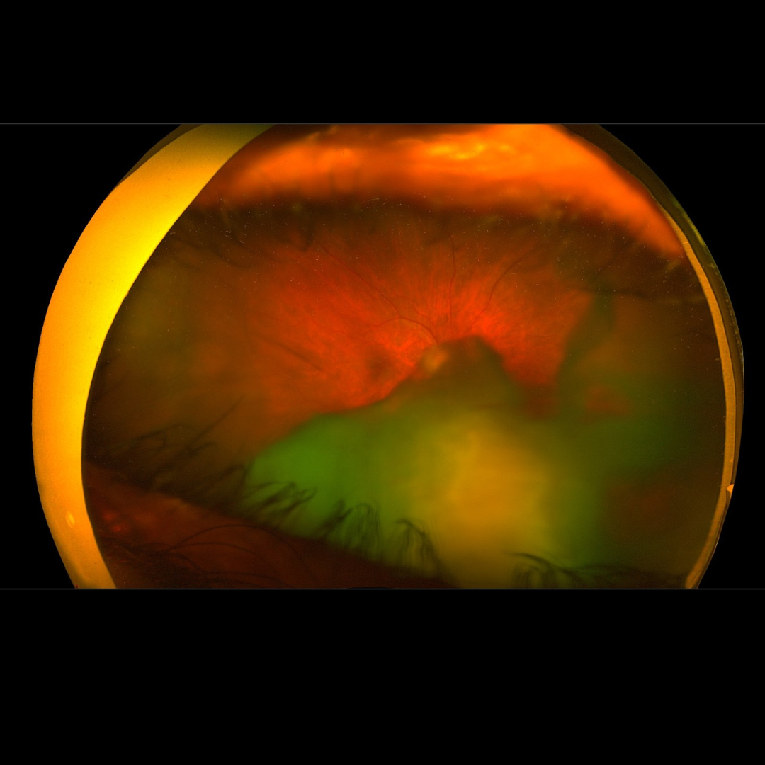 Dr. Mandeep Lamba specializes in managing complications of cataract surgery in Dubai, offering expert care for safe and effective recovery.