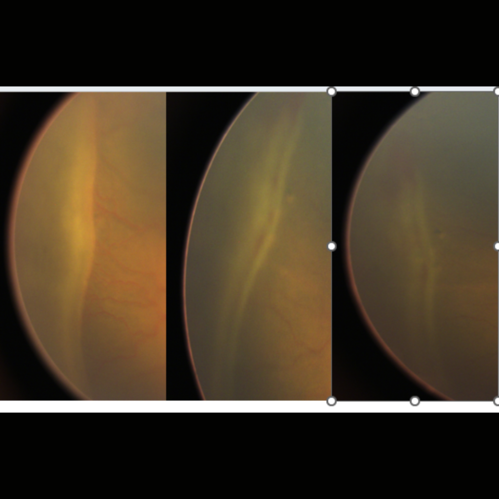 Dr. Mandeep Lamba offers advanced ROP treatment in Dubai. Expert care for Retinopathy of Prematurity to protect your child's vision.