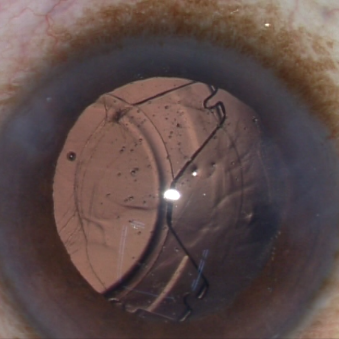 Dr. Mandeep Lamba specializes in Glued IOL and scleral-fixed lens procedures in Dubai, offering advanced solutions for stable and long-lasting vision.