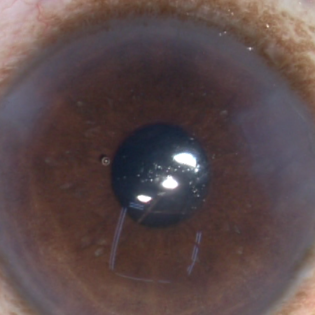 Trust Dr. Mandeep Lamba for expert Glued IOL and scleral-fixed lens procedures in Dubai. Dedicated care for secure, stable, and lasting visual improvement!