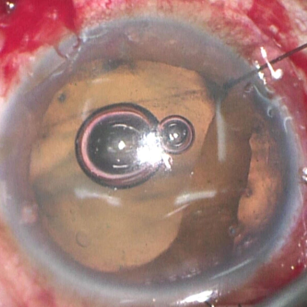 Advanced anterior segment trauma treatment in Dubai! Dr. Mandeep Lamba delivers expert solutions for eye injuries with precision and care.