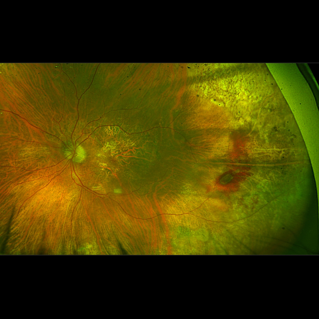 Age-Related Macular Degeneration (AMD) 1 Specialized Age-Related Macular Degeneration (AMD) care by Dr. Mandeep Lamba in Dubai