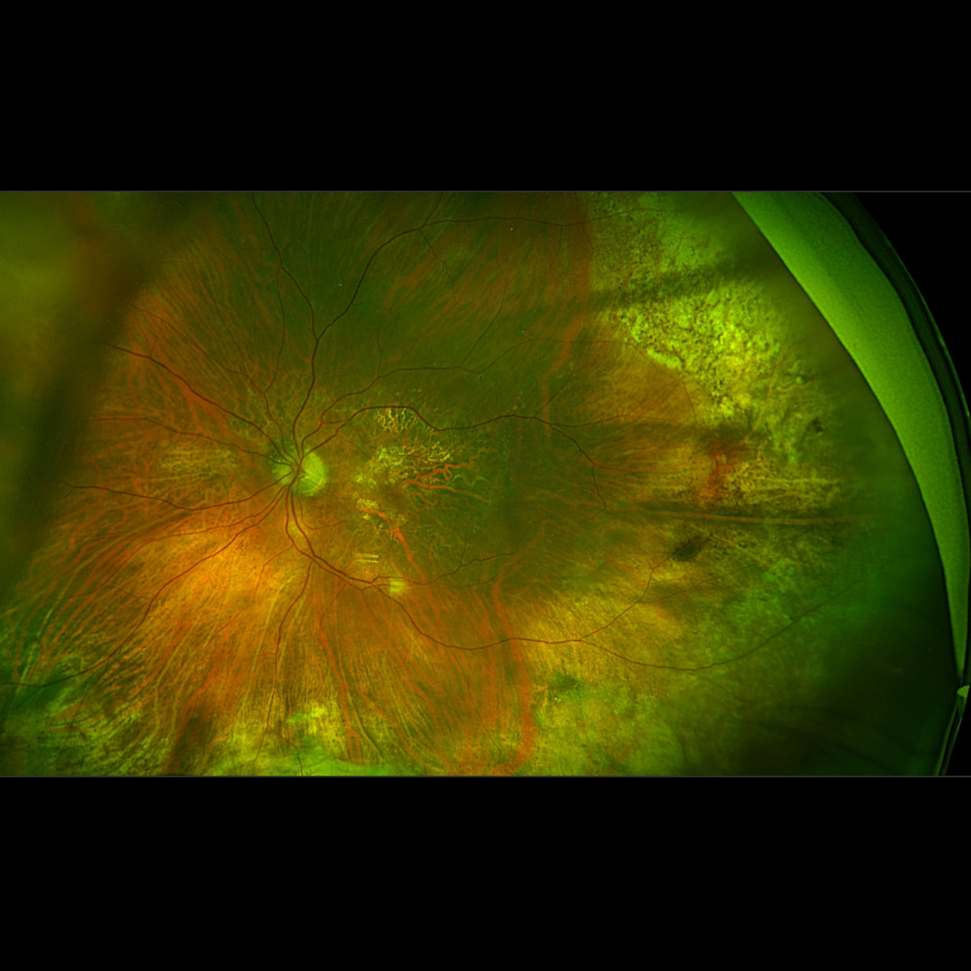 Effective AMD care in Dubai by Dr. Mandeep Lamba.