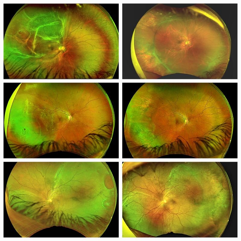 Scleral Buckling Saves Complex Retinas Prime Hospital