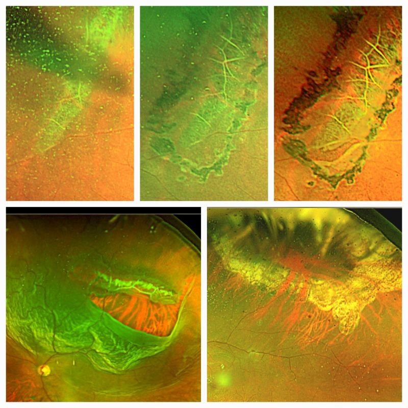 Dr. Mandeep Lamba discusses lattice retinal degeneration, increasing detachment risks. Explore its causes, symptoms, and advanced treatments available.