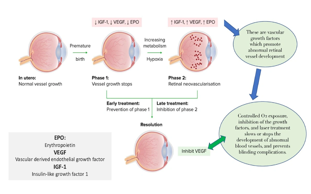 ROP doesn’t have to steal your baby’s sight. Understand when to screen, which babies are at risk and how fast treatment can prevent blindness.