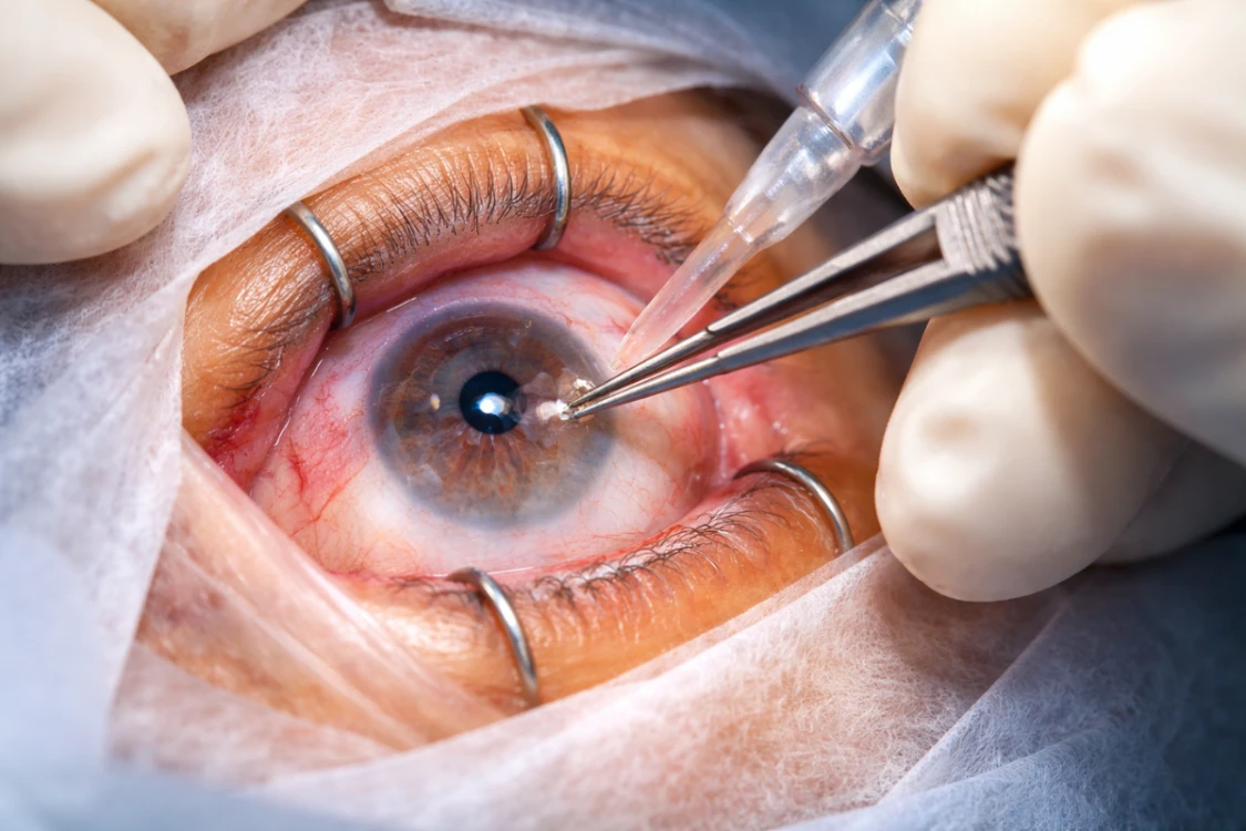 Intraocular Foreign Bodies Are Removing from eye
