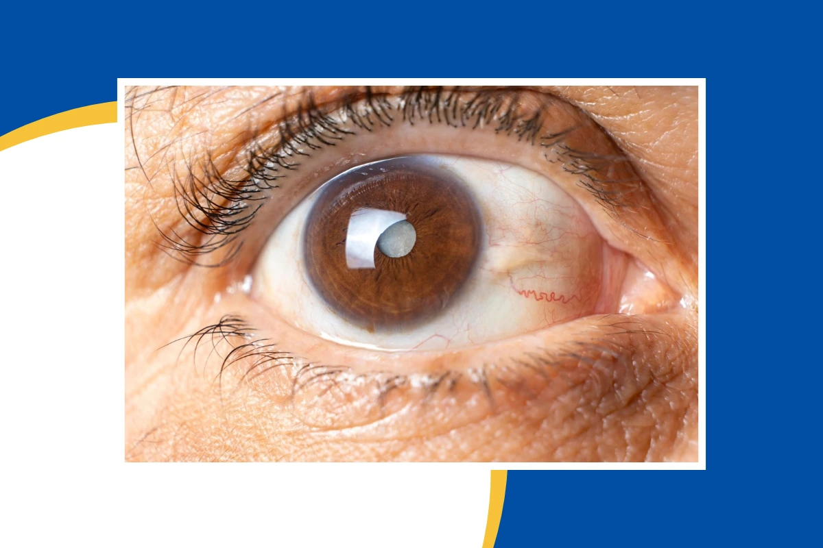 Close-up of an eye showing visible changes associated with glaucoma