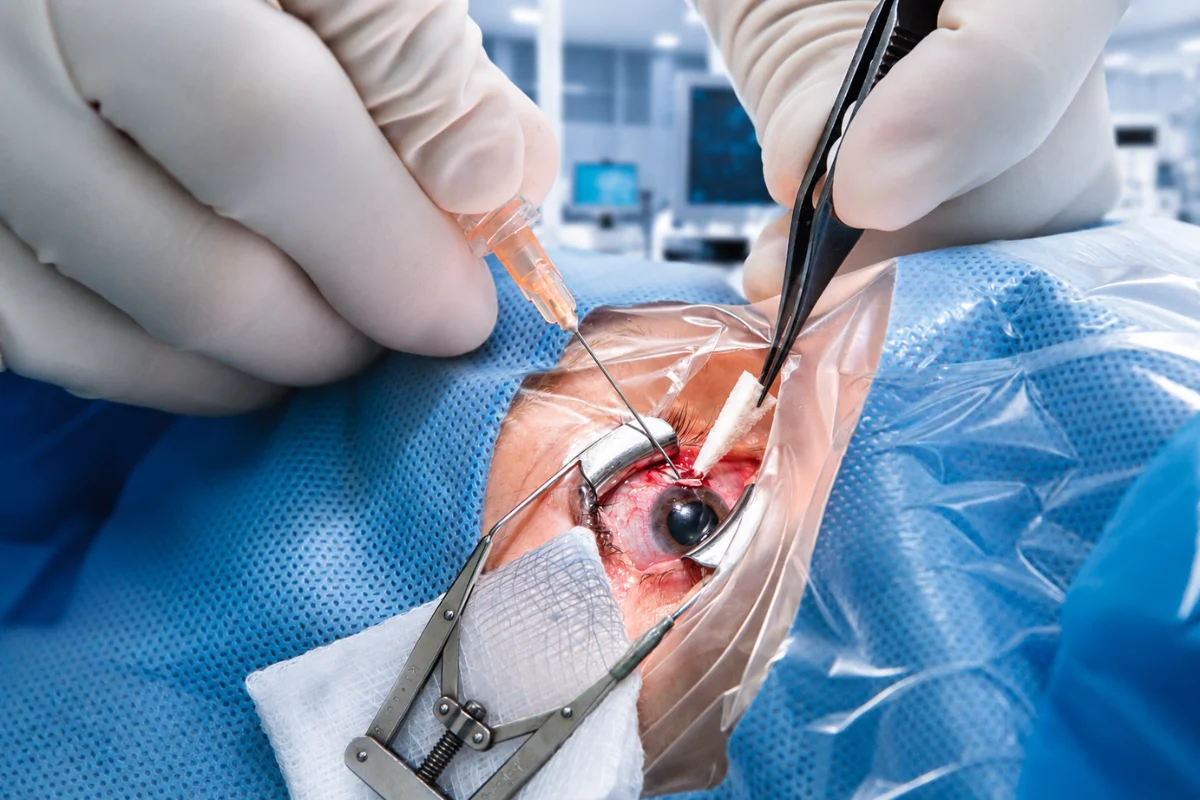 Close-up of an eye during glaucoma surgery performed by an ophthalmic surgeon