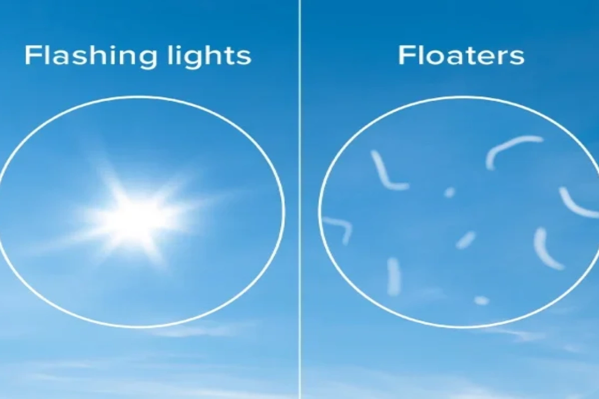 Visual representation of flashing lights and floaters in the eye indicating a need for a detailed retinal assessment